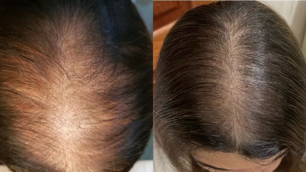 Antes e depois de tratamento de queda capilar
